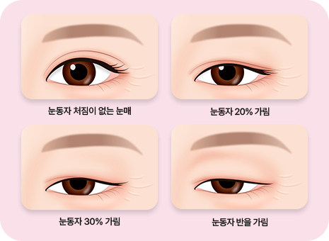 눈매 처짐 진단 이미지