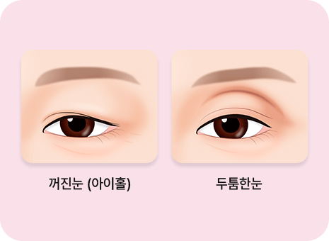 눈꺼풀의 볼륨 이미지